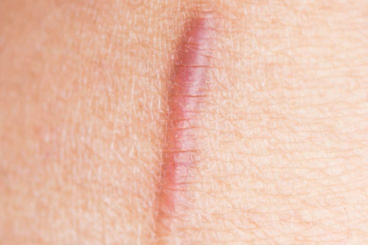 Sẹo lồi: Nguyên nhân, triệu chứng và cách phòng ngừa